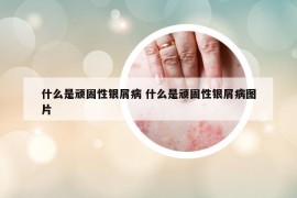 什么是頑固性銀屑病 什么是頑固性銀屑病圖片