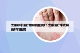 太原那家治療銀屑病醫(yī)院好 太原治療牛皮癬最好的醫(yī)院