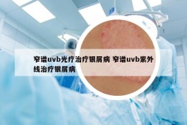 窄譜uvb光療治療銀屑病 窄譜uvb紫外線治療銀屑病