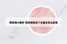銀屑病m囊腫 銀屑病變成了毛囊炎怎么回事