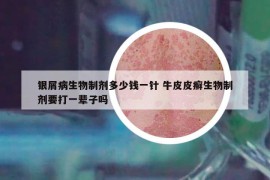 銀屑病生物制劑多少錢(qián)一針 牛皮皮癬生物制劑要打一輩子嗎