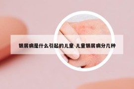 銀屑病是什么引起的兒童 兒童銀屑病分幾種