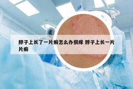 脖子上長了一片癬怎么辦很癢 脖子上長一片片癬