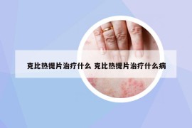 克比熱提片治療什么 克比熱提片治療什么病