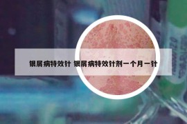 銀屑病特效針 銀屑病特效針劑一個月一針
