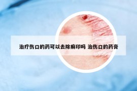 治療傷口的藥可以去除癬印嗎 治傷口的藥膏