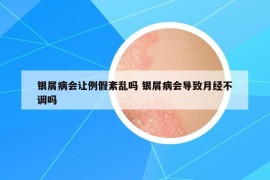 銀屑病會讓例假紊亂嗎 銀屑病會導(dǎo)致月經(jīng)不調(diào)嗎