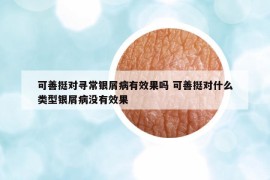 可善挺對尋常銀屑病有效果嗎 可善挺對什么類型銀屑病沒有效果