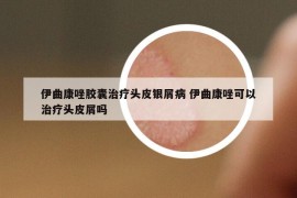 伊曲康唑膠囊治療頭皮銀屑病 伊曲康唑可以治療頭皮屑嗎