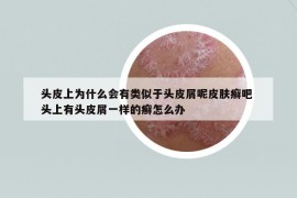 頭皮上為什么會(huì)有類似于頭皮屑呢皮膚癬吧 頭上有頭皮屑一樣的癬怎么辦