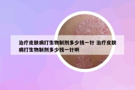 治療皮膚病打生物制劑多少錢一針 治療皮膚病打生物制劑多少錢一針啊