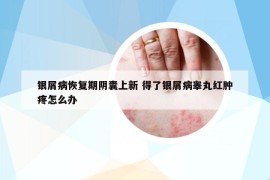 銀屑病恢復(fù)期陰囊上新 得了銀屑病睪丸紅腫疼怎么辦