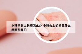 小孩子頭上長癬怎么辦 小孩頭上的癬是什么原因引起的