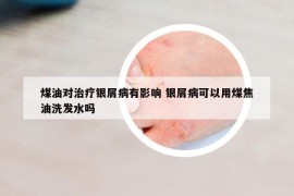 煤油對(duì)治療銀屑病有影響 銀屑病可以用煤焦油洗發(fā)水嗎