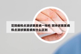 花斑癬和點滴狀銀屑病一樣嗎 斑塊狀銀屑病和點滴狀銀屑病有什么區(qū)別