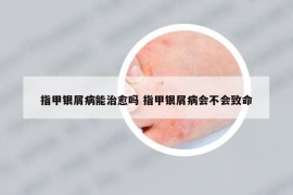 指甲銀屑病能治愈嗎 指甲銀屑病會不會致命