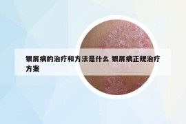 銀屑病的治療和方法是什么 銀屑病正規(guī)治療方案