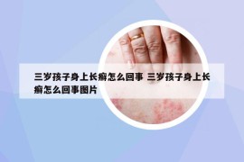 三歲孩子身上長癬怎么回事 三歲孩子身上長癬怎么回事圖片