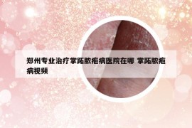 鄭州專業(yè)治療掌跖膿皰病醫(yī)院在哪 掌跖膿皰病視頻