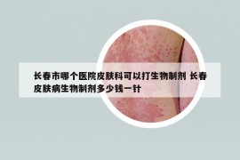 長(zhǎng)春市哪個(gè)醫(yī)院皮膚科可以打生物制劑 長(zhǎng)春皮膚病生物制劑多少錢一針