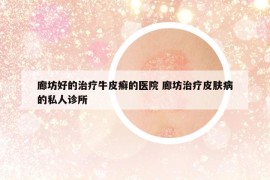 廊坊好的治療牛皮癬的醫(yī)院 廊坊治療皮膚病的私人診所