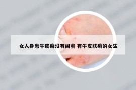 女人身患牛皮癬沒有閨蜜 有牛皮膚癬的女生
