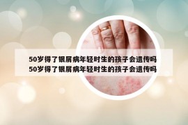 50歲得了銀屑病年輕時(shí)生的孩子會(huì)遺傳嗎 50歲得了銀屑病年輕時(shí)生的孩子會(huì)遺傳嗎
