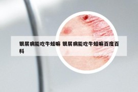 銀屑病能吃牛蛙嘛 銀屑病能吃牛蛙嘛百度百科