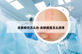 皮膚癬該怎么辦 皮膚癬是怎么回事