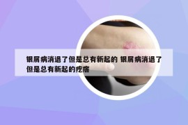 銀屑病消退了但是總有新起的 銀屑病消退了但是總有新起的疙瘩