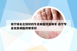 南寧排名比較好的牛皮癬醫(yī)院是哪家 南寧專業(yè)皮膚病醫(yī)院哪家好