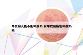 牛皮癬人能不能喝酸奶 有牛皮病癬能喝酸奶嗎