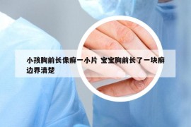 小孩胸前長像癬一小片 寶寶胸前長了一塊癬邊界清楚