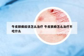 牛皮膚癬應(yīng)該怎么治療 牛皮膚癬怎么治療不吃什么