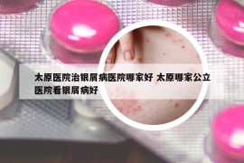 太原醫(yī)院治銀屑病醫(yī)院哪家好 太原哪家公立醫(yī)院看銀屑病好