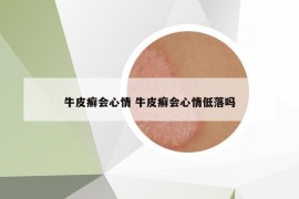 牛皮癬會(huì)心情 牛皮癬會(huì)心情低落嗎