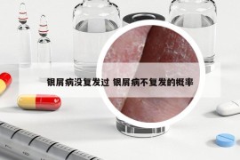銀屑病沒復(fù)發(fā)過 銀屑病不復(fù)發(fā)的概率