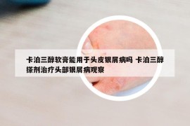 卡泊三醇軟膏能用于頭皮銀屑病嗎 卡泊三醇搽劑治療頭部銀屑病觀察