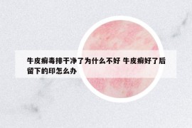 牛皮癬毒排干凈了為什么不好 牛皮癬好了后留下的印怎么辦