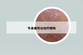 牛皮癬可以吃檸檬嗎