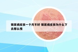 銀屑病皮損一個月不好 銀屑病皮損為什么下去那么慢