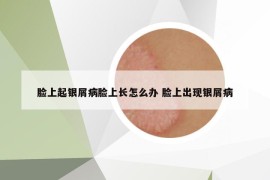 臉上起銀屑病臉上長怎么辦 臉上出現(xiàn)銀屑病