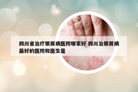 四川省治療銀屑病醫(yī)院哪家好 四川治銀屑病最好的醫(yī)院和醫(yī)生是