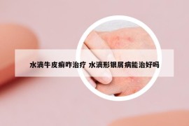 水滴牛皮癬咋治療 水滴形銀屑病能治好嗎