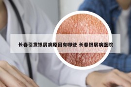 長(zhǎng)春引發(fā)銀屑病原因有哪些 長(zhǎng)春銀屑病醫(yī)院