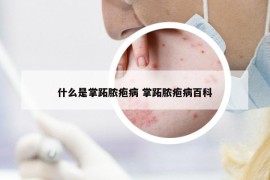 什么是掌跖膿皰病 掌跖膿皰病百科
