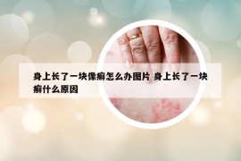 身上長了一塊像癬怎么辦圖片 身上長了一塊癬什么原因