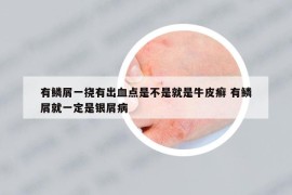 有鱗屑一撓有出血點(diǎn)是不是就是牛皮癬 有鱗屑就一定是銀屑病