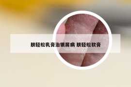 膚輕松乳膏治銀屑病 膚輕松軟膏