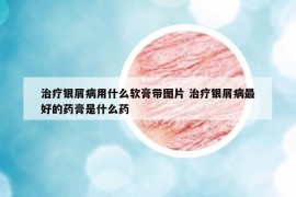 治療銀屑病用什么軟膏帶圖片 治療銀屑病最好的藥膏是什么藥